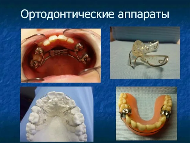 Ортодонтические аппараты