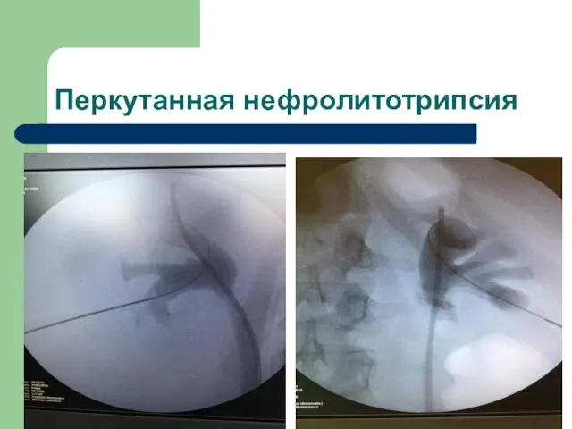 Перкутанная нефролитотрипсия