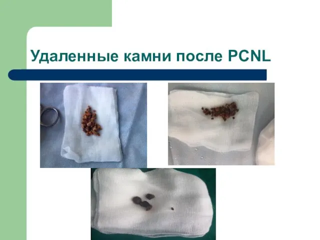 Удаленные камни после PCNL