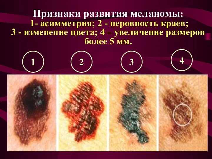 Признаки развития меланомы: 1- асимметрия; 2 - неровность краев; 3