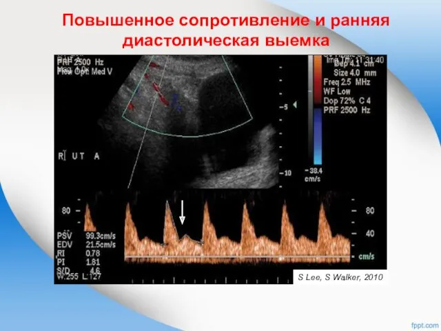 Повышенное сопротивление и ранняя диастолическая выемка S Lee, S Walker, 2010