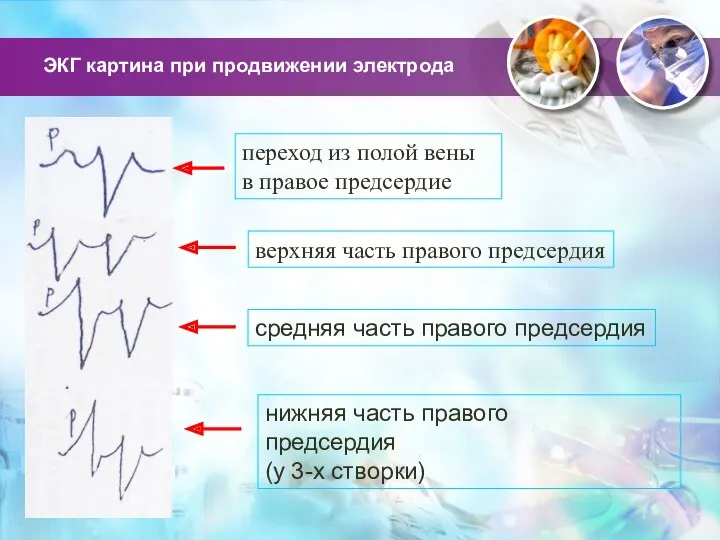 ЭКГ картина при продвижении электрода переход из полой вены в