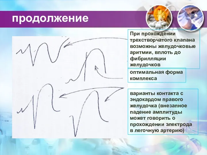 продолжение При прохождении трехстворчатого клапана возможны желудочковые аритмии, вплоть до