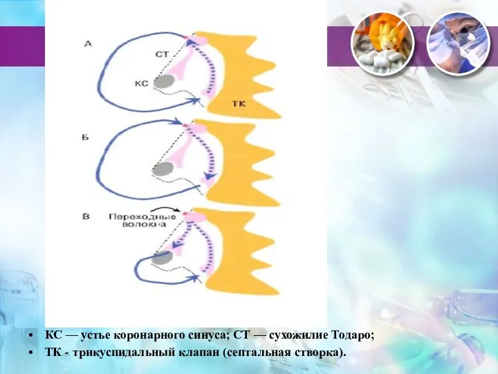 КС — устье коронарного синуса; СТ — сухожилие Тодаро; ТК - трикуспидальный клапан (септальная створка).