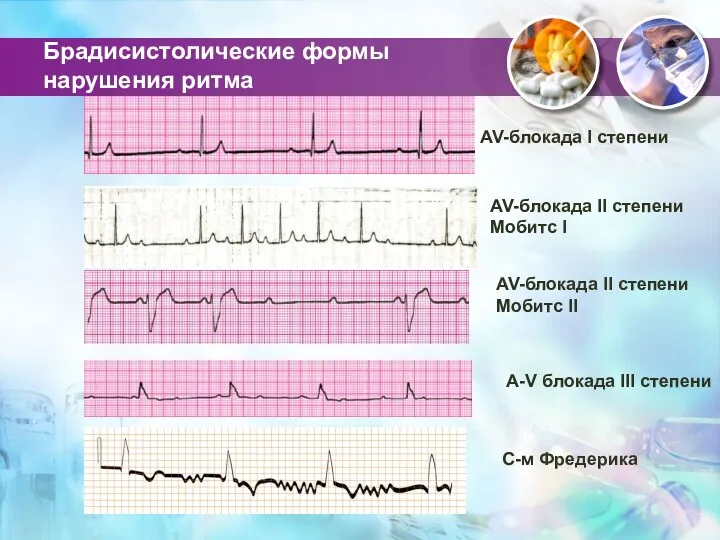 Брадисистолические формы нарушения ритма AV-блокада II степени Мобитс I AV-блокада