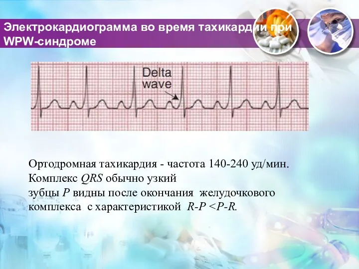 Электрокардиограмма во время тахикардии при WPW-синдроме Ортодромная тахикардия - частота