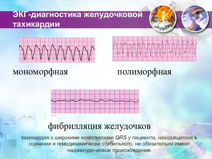 ЭКГ-диагностика желудочковой тахикардии мономорфная полиморфная фибрилляция желудочков тахикардия с широкими