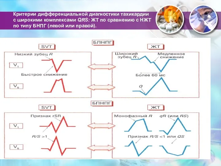 Критерии дифференциальной диагностики тахикардии с широкими комплексами QRS: ЖТ по