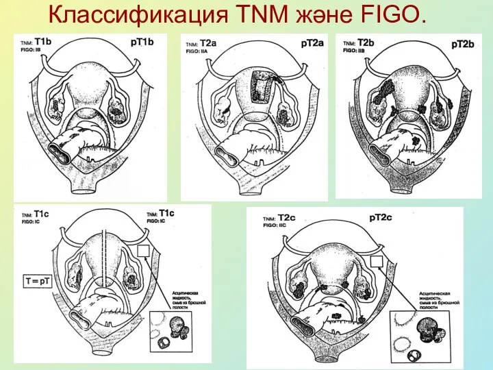 Классификация TNM және FIGO.