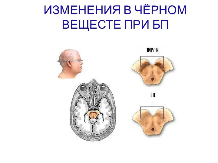 ИЗМЕНЕНИЯ В ЧЁРНОМ ВЕЩЕСТЕ ПРИ БП