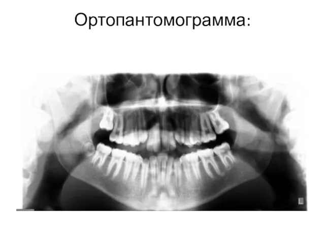Ортопантомограмма: