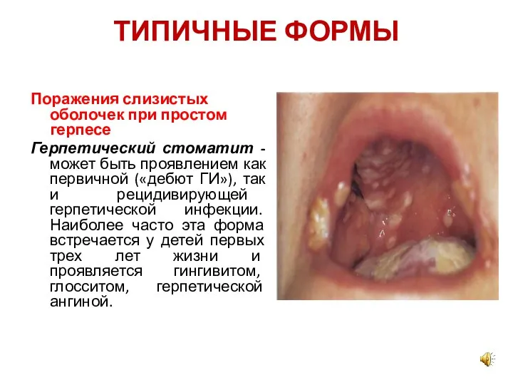 ТИПИЧНЫЕ ФОРМЫ Поражения слизистых оболочек при простом герпесе Герпетический стоматит - может быть