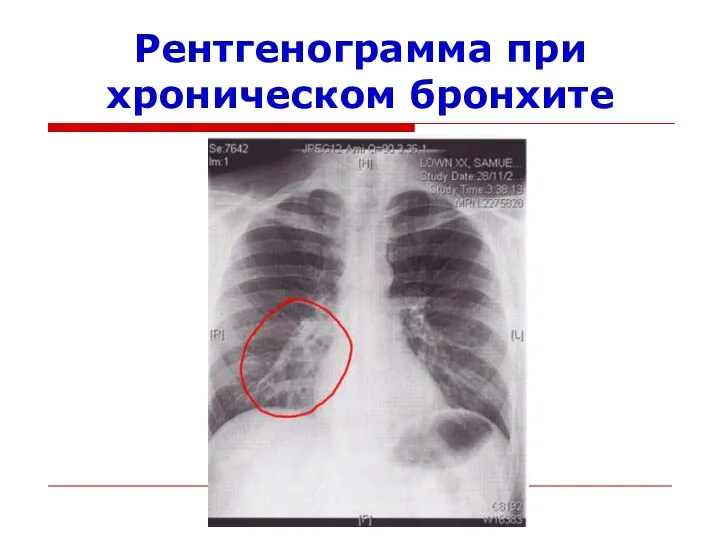 Рентгенограмма при хроническом бронхите