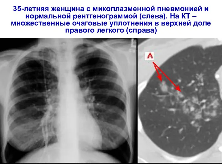 35-летняя женщина с микоплазменной пневмонией и нормальной рентгенограммой (слева). На