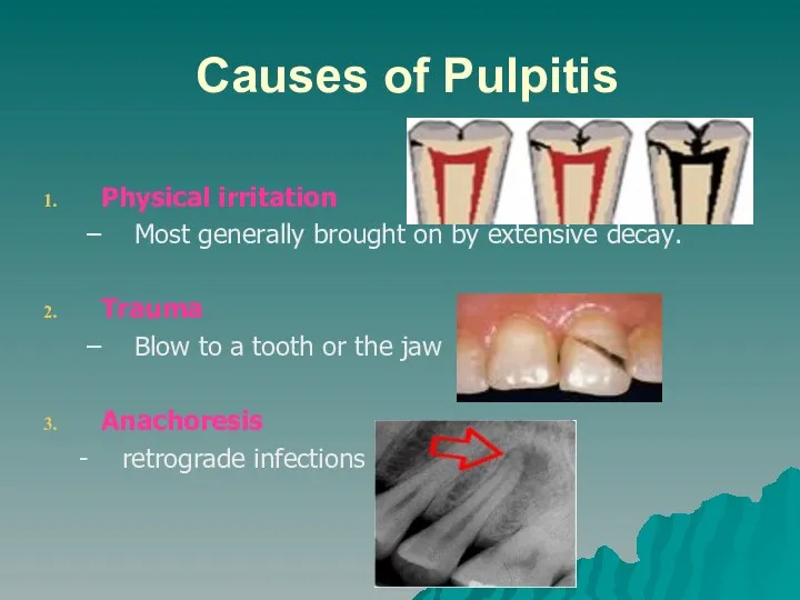 Causes of Pulpitis Physical irritation Most generally brought on by