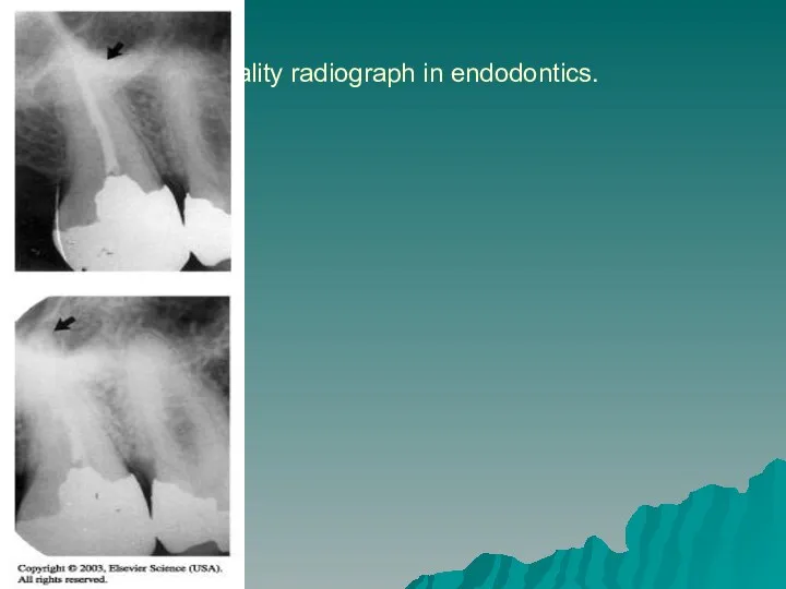 Quality radiograph in endodontics.