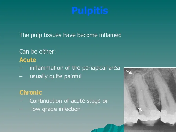 Pulpitis The pulp tissues have become inflamed Can be either: