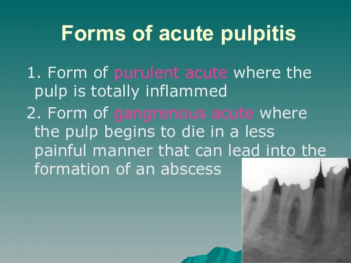 Forms of acute pulpitis 1. Form of purulent acute where