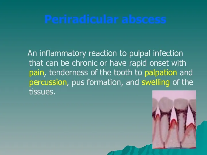 Periradicular abscess An inflammatory reaction to pulpal infection that can