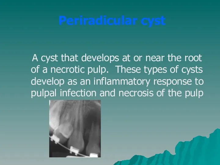Periradicular cyst A cyst that develops at or near the