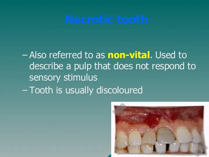 Necrotic tooth Also referred to as non-vital. Used to describe