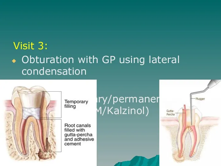 Visit 3: Obturation with GP using lateral condensation Placed temporary/permanent restoration (IRM/Kalzinol)