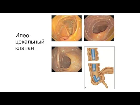 Илео-цекальный клапан