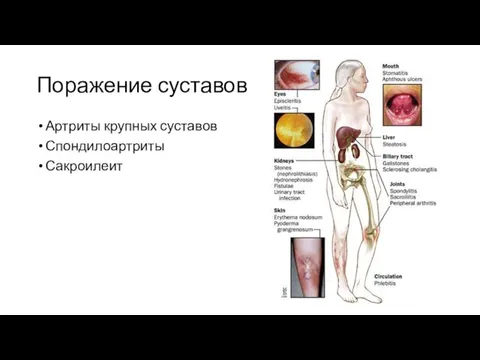 Поражение суставов Артриты крупных суставов Спондилоартриты Сакроилеит