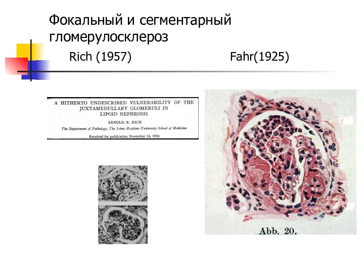 Фокальный и сегментарный гломерулосклероз Rich (1957) Fahr(1925)