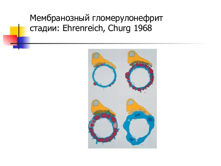 Мембранозный гломерулонефрит стадии: Ehrenreich, Churg 1968