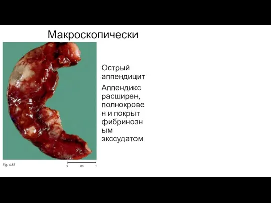 Макроскопически Острый аппендицит Аппендикс расширен, полнокровен и покрыт фибринозным экссудатом