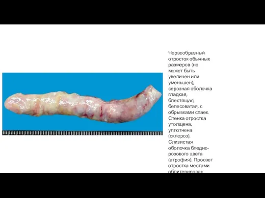 Червеобразный отросток обычных размеров (но может быть увеличен или уменьшен),