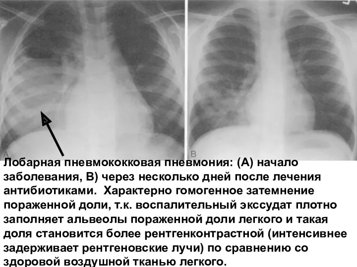 Лобарная пневмококковая пневмония: (А) начало заболевания, В) через несколько дней