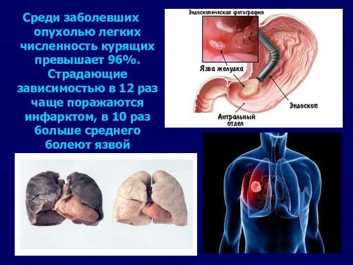 Среди заболевших опухолью легких численность курящих превышает 96%. Страдающие зависимостью