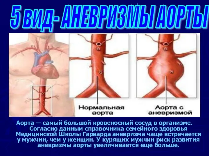 Аорта — самый большой кровеносный сосуд в организме. Согласно данным