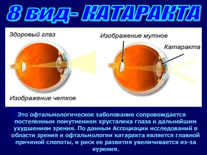 Это офтальмологическое заболевание сопровождается постепенным помутнением хрусталика глаза и дальнейшим