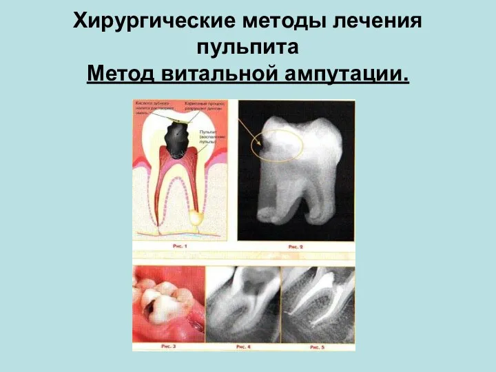 Хирургические методы лечения пульпита Метод витальной ампутации.