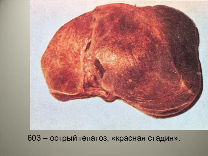 603 – острый гепатоз, «красная стадия».
