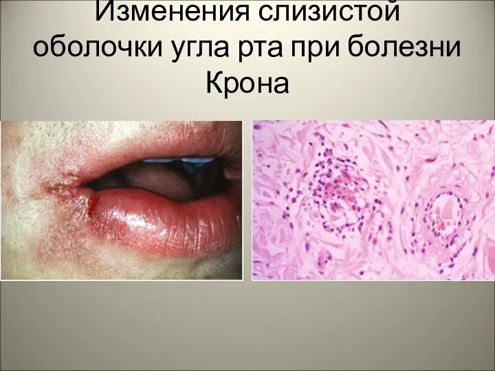 Изменения слизистой оболочки угла рта при болезни Крона
