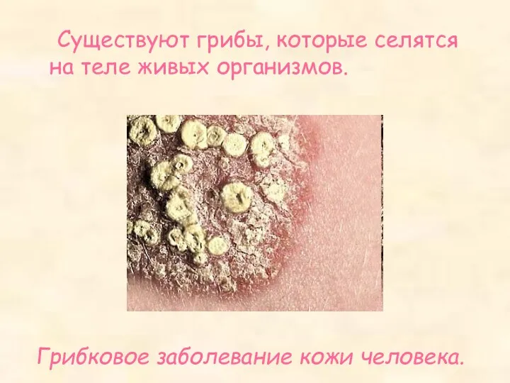 Существуют грибы, которые селятся на теле живых организмов. Грибковое заболевание кожи человека.