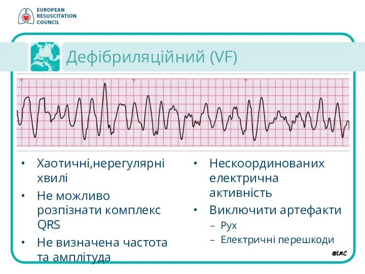 Дефібриляційний (VF) Нескоординованих електрична активність Виключити артефакти Рух Eлектричні перешкоди