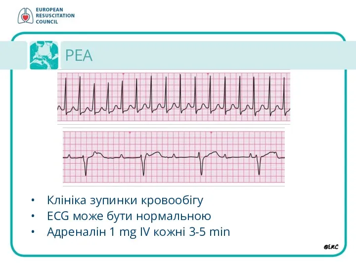 PEA Клініка зупинки кровообігу ECG може бути нормальною Aдреналін 1 mg IV кожні 3-5 min