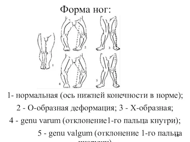 Форма ног: