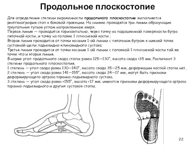 Продольное плоскостопие Для определения степени выраженности продольного плоскостопия выполняется рентгенография