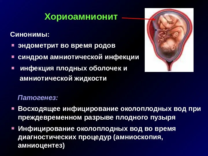 Хориоамнионит Синонимы: эндометрит во время родов синдром амниотической инфекции инфекция