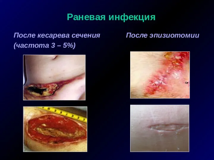 Раневая инфекция После кесарева сечения После эпизиотомии (частота 3 – 5%)