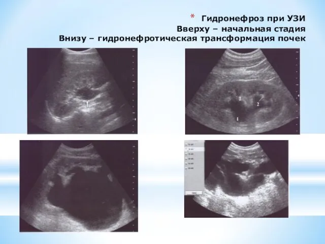 Гидронефроз при УЗИ Вверху – начальная стадия Внизу – гидронефротическая трансформация почек