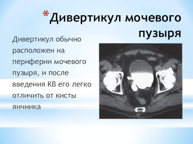 Дивертикул мочевого пузыря Дивертикул обычно расположен на периферии мочевого пузыря, и после введения