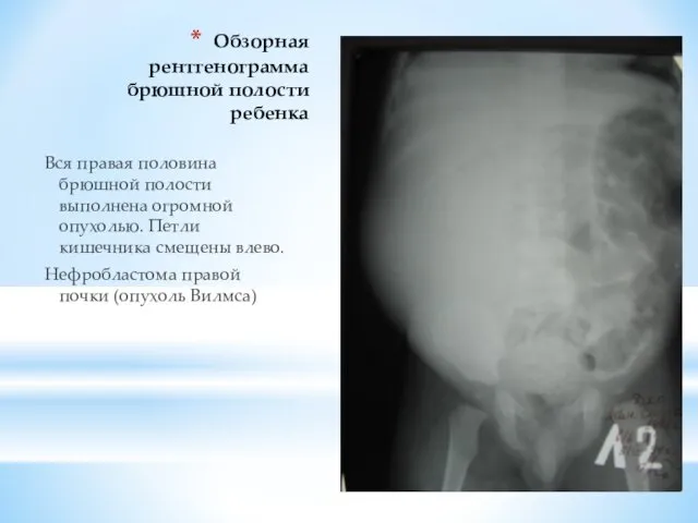 Обзорная рентгенограмма брюшной полости ребенка Вся правая половина брюшной полости выполнена огромной опухолью.