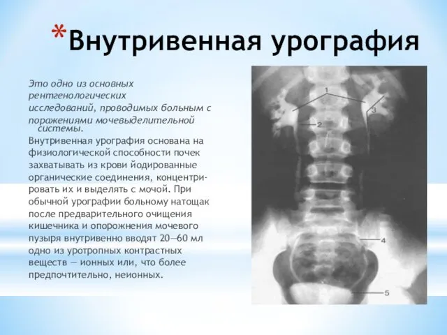 Внутривенная урография Это одно из основных рентгенологических исследований, проводимых больным с поражениями мочевыделительной